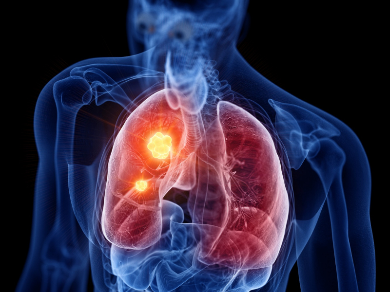 Anatomische Segmentresektionen beim Lungenkrebs